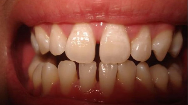 Răng cửa bị thưa là tình trạng khe hở giữa hai răng cửa lớn hơn bình thường, ảnh hưởng đến thẩm mỹ nụ cười và có thể dẫn đến nhiều vấn đề về sức khỏe răng miệng. Vậy nguyên nhân nào dẫn đến tình trạng này, nó ảnh hưởng như thế nào và giải pháp nào hiệu quả nhất?